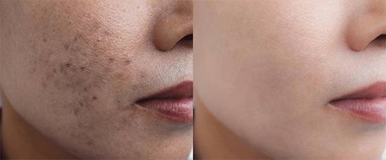 The Best Vitamin to Remove Age Spots Naturally, According to Skin Experts