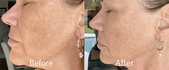 The Best Vitamin to Remove Age Spots Naturally, According to Skin Experts